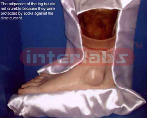 Adipocere of the leg